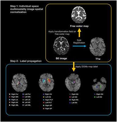 Quantifying neuroinflammation within deep gray matter in small vessel disease using diffusion tensor based free-water imaging: a longitudinal study